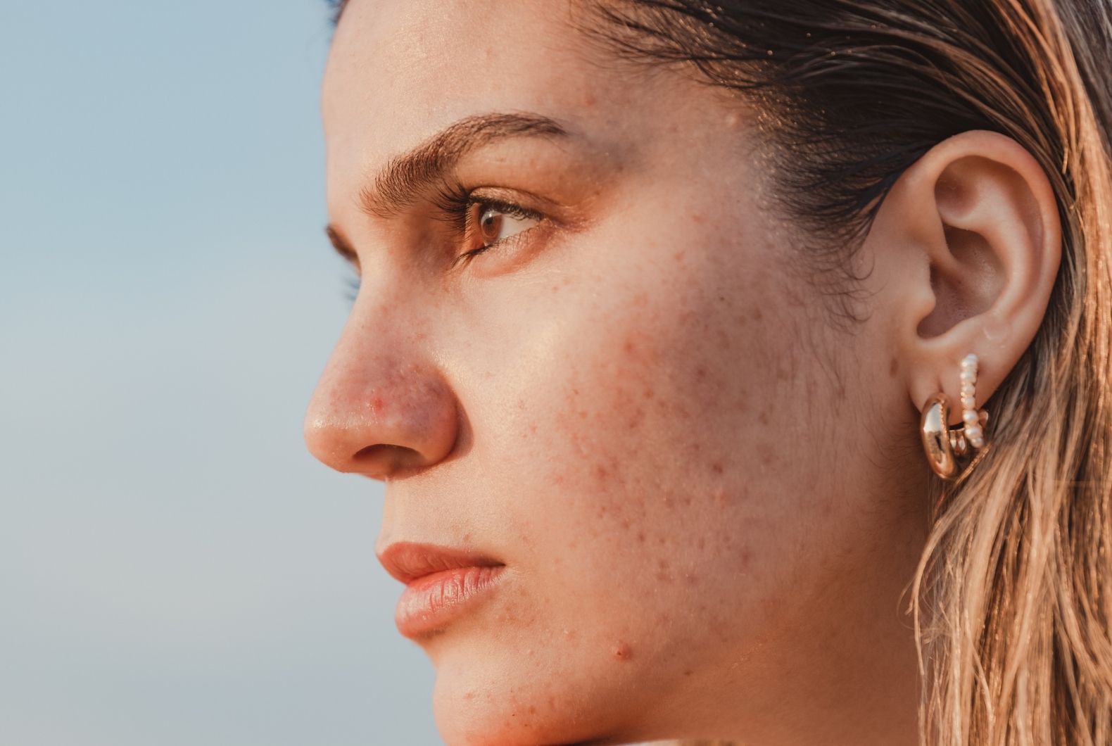 Acné facial